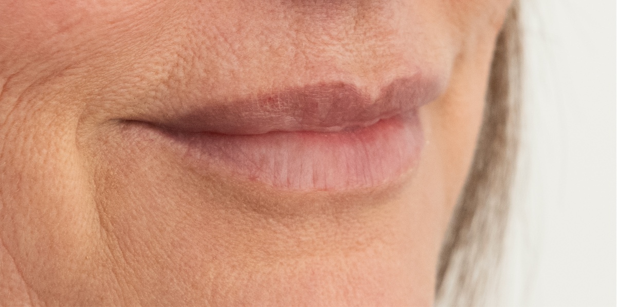 Iniezioni per l'aumento delle labbra: e se fossero adatte a te?